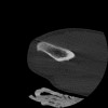 SPORK, NICO - 22.03.1976 - 02.08.2022 - CT obere Extremität - 17:51:17